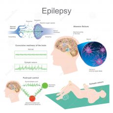 Concept despre stigmatizarea pacienților cu epilepsie